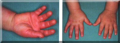 Die Behandlung mit einer Charismon®-Creme bei thermischer Verletzung von 4% Körperoberfläche bei einem neun Monate alten Knaben.